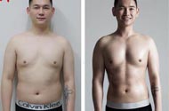 抽脂手术 型男又回来了哦